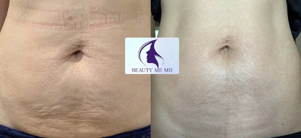 Potenza RF-Microneedling - RF-MICRONEEDLING: can treat a wide variety of skin concerns on the face and body. This includes treating signs of aging and sun damage like fine lines and wrinkles. It can also help treat acne scars, stretch marks, skin irregularities and shrink pores.
