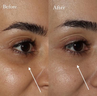Under Eye Correction - We can help fill in volume loss under the eyes or camouflage under eye bags with the help of dermal fillers. Under Eye Correction - We can help fill in volume loss under the eyes or camouflage under eye bags with the help of dermal fillers.