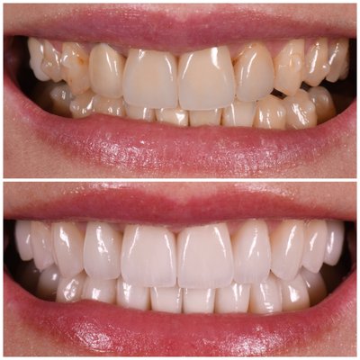 Cosmetic Cases: Before & Afters - We love to enhance smiles and have expertly created a niche in the field creating absolutely natural looking results! We look forward to meeting you! Cosmetic Cases: Before & Afters - We love to enhance smiles and have expertly created a niche in the field creating absolutely natural looking results! We look forward to meeting you!