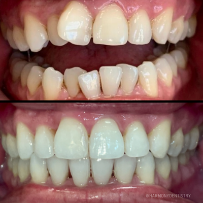 Invisalign before and after - At Harmony Dentistry, Dr. Ash transforms smiles with care and precision. Our before-and-after portfolio showcases radiant, natural results in a warm, spotless office. Using cutting-edge technology, we create confident smiles in a comfortable, patient-focused environment. Invisalign before and after - At Harmony Dentistry, Dr. Ash transforms smiles with care and precision. Our before-and-after portfolio showcases radiant, natural results in a warm, spotless office. Using cutting-edge technology, we create confident smiles in a comfortable, patient-focused environment.