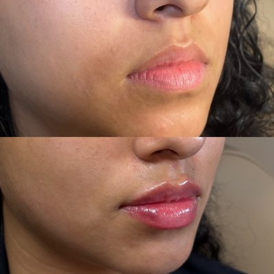 Before and Afters - 704aesthetics is a space where beauty, safety, and personalized care come together. Our mission is simple: to empower clients through subtle, natural enhancements delivered with integrity and expertise.