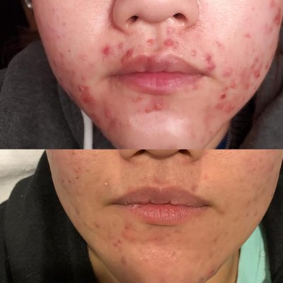 IPL therapy to treat acne, wrinkles, skin tightening and sun damage. - This client needed help with Acne so we utilized our IPL treatment which treats acne with no pain or downtime by inducing collagen production while killing bacteria and repairing itself to a more youthful look. IPL treatments are great for age regression as it tightens the skin and reduces wrinkles. IPL therapy to treat acne, wrinkles, skin tightening and sun damage. - This client needed help with Acne so we utilized our IPL treatment which treats acne with no pain or downtime by inducing collagen production while killing bacteria and repairing itself to a more youthful look. IPL treatments are great for age regression as it tightens the skin and reduces wrinkles.