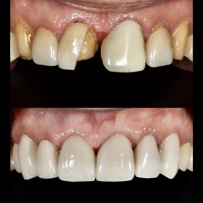 Crowns and Bridges - Crowns and bridges are a great service for renewing broken down teeth and teeth with large fillings. Crowns and Bridges - Crowns and bridges are a great service for renewing broken down teeth and teeth with large fillings.