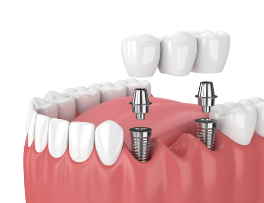 Services Offered - We are a preferred provider for many of the most recognized insurance companies and will assist you in all the processing and paperwork necessary. Remember that most dental insurance covers the initial exam and x-rays at no out-of-pocket cost to you! We accept most PPO insurance plans from these prestigious companies and more: Services Offered - We are a preferred provider for many of the most recognized insurance companies and will assist you in all the processing and paperwork necessary. Remember that most dental insurance covers the initial exam and x-rays at no out-of-pocket cost to you! We accept most PPO insurance plans from these prestigious companies and more: