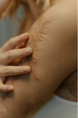 EXPERT SCAR TISSUE MASSAGE FOR BURNED & INJURED SKIN - If you're struggling with burned / injured skin, our trained therapists are here to help. Our specialized scare tissue massage can help alleviate pain, reduce inflammation, and improve range of motion.
Our team is dedicated to providing a safe and supportive environment for clients with sensitive skin. We understand the unique challenges of working with burned and injured skin, and we're committed to helping you achieve optimal healing and recovery.
Benefits of our scar tissue massage includes:
• Reduced pain and discomfort
• Improves range of motion and flexibility
• Enhance wound healing and tissue repair
• Reduce appearance of scare and adhesions EXPERT SCAR TISSUE MASSAGE FOR BURNED & INJURED SKIN - If you're struggling with burned / injured skin, our trained therapists are here to help. Our specialized scare tissue massage can help alleviate pain, reduce inflammation, and improve range of motion.
Our team is dedicated to providing a safe and supportive environment for clients with sensitive skin. We understand the unique challenges of working with burned and injured skin, and we're committed to helping you achieve optimal healing and recovery.
Benefits of our scar tissue massage includes:
• Reduced pain and discomfort
• Improves range of motion and flexibility
• Enhance wound healing and tissue repair
• Reduce appearance of scare and adhesions
