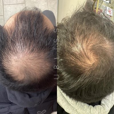 Hair PRP - Platelet-rich plasma (PRP) injections are gaining popularity for hair loss. The treatment uses a patient’s own blood cells to accelerate healing in a specific area or hair regrowth. The technique can address male pattern baldness, stimulate the growth of hair transplants and enhance other cosmetic procedures.The treatments use patient’s own plasma, thus making it safe and effective. Hair PRP - Platelet-rich plasma (PRP) injections are gaining popularity for hair loss. The treatment uses a patient’s own blood cells to accelerate healing in a specific area or hair regrowth. The technique can address male pattern baldness, stimulate the growth of hair transplants and enhance other cosmetic procedures.The treatments use patient’s own plasma, thus making it safe and effective.