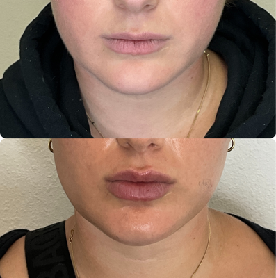 Fillers - Enhance your natural beauty with expertly placed fillers. Whether you’re looking to add volume, smooth wrinkles, or achieve facial balance, our customized treatments are designed to help you look refreshed and radiant. Fillers - Enhance your natural beauty with expertly placed fillers. Whether you’re looking to add volume, smooth wrinkles, or achieve facial balance, our customized treatments are designed to help you look refreshed and radiant.