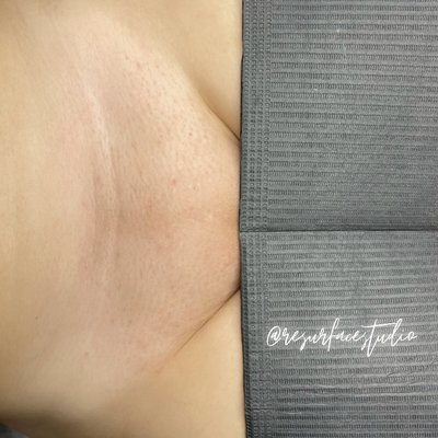 Full Body Waxing - Ask about our wax bar! We offer full body waxing on all areas including: under arms, legs, bikini, brazilians, arms, nostril, back, stomach, etc.
We use both soft and hard wax for all skin and hair types. Full Body Waxing - Ask about our wax bar! We offer full body waxing on all areas including: under arms, legs, bikini, brazilians, arms, nostril, back, stomach, etc.
We use both soft and hard wax for all skin and hair types.