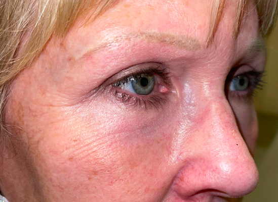 Four lid blepharoplasty with laser resurfacing - This patient had a four lid blepharoplasty (bilateral upper and lower eyelid surgery) and CO2 laser resurfacing. This rejuvenation helped her feel more confident look more well rested.