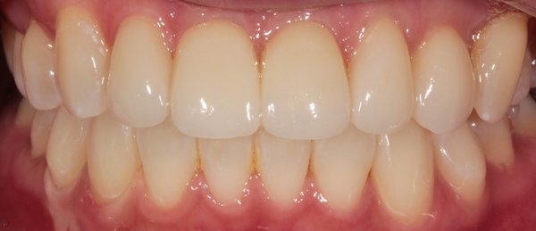 Veneers after Ortho - Sometimes you need veneers and cosmetic dentistry in addition to orthodontics to give patients the best smile possible. This is a perfect example to show a beautiful smile makeover completed by Dr. Hoda Bassiri. Veneers after Ortho - Sometimes you need veneers and cosmetic dentistry in addition to orthodontics to give patients the best smile possible. This is a perfect example to show a beautiful smile makeover completed by Dr. Hoda Bassiri.