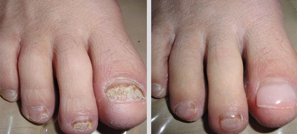 KeryFlex Nail Restoration - KeryFlex application is a cosmetic procedure and not intended to cure a disease. Ideal candidates have mild to moderate impairment caused by:
Nail fungus
Nail shape changes due to injury
Spoon shaped nails
Brittle and splitting nails
Horizontal ridges
Discolored nails
Ask your foot care provider if KeryFlex Nail Restoration is right for you. KeryFlex Nail Restoration - KeryFlex application is a cosmetic procedure and not intended to cure a disease. Ideal candidates have mild to moderate impairment caused by:
Nail fungus
Nail shape changes due to injury
Spoon shaped nails
Brittle and splitting nails
Horizontal ridges
Discolored nails
Ask your foot care provider if KeryFlex Nail Restoration is right for you.