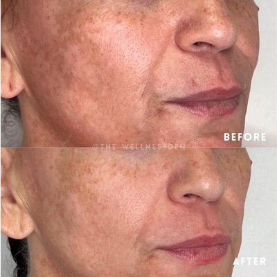 Moxi treatment - Looking for a treatment that is gentle and non-ablative fractional? Moxi laser is designed to address Melasma, Pigmentation & Sun Damage, Uneven Skin Tone, Texture Improvement, Signs of Aging and is FDA-cleared for addressing actinic keratosis, a precancerous skin condition

This laser treatment suits all skin types, requires minimal downtime, and boosts collagen for smoother, clearer skin.