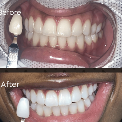 Teeth Whitening - Brighten your smile with our professional teeth whitening service in the ATL Metro area! Experience noticeably whiter teeth in just one session, with safe, effective treatments tailored for your comfort and confidence.
Click here to book online: https://theperfectbrows.com/booking/
or
Call +1404-816-5392 Teeth Whitening - Brighten your smile with our professional teeth whitening service in the ATL Metro area! Experience noticeably whiter teeth in just one session, with safe, effective treatments tailored for your comfort and confidence.
Click here to book online: https://theperfectbrows.com/booking/
or
Call +1404-816-5392