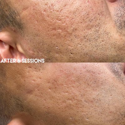 Micro-needling - Micro-needling/Skin-needling is also known as Collagen Induction Therapy which is a cosmetic procedure that involves puncturing the skin with tiny, sterile needles so that old skin can shed and new skin can grow. This is good for those that have acne scars, large pores, uneven skin texture, and hyperpigmentation. This is NOT good for those with active cyst acne. 30 mins of topical numbing is provided for optimal comfort and we finish with a FREE collagen face mask! Micro-needling - Micro-needling/Skin-needling is also known as Collagen Induction Therapy which is a cosmetic procedure that involves puncturing the skin with tiny, sterile needles so that old skin can shed and new skin can grow. This is good for those that have acne scars, large pores, uneven skin texture, and hyperpigmentation. This is NOT good for those with active cyst acne. 30 mins of topical numbing is provided for optimal comfort and we finish with a FREE collagen face mask!