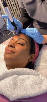 Micro-Needling - Microneedling is a cosmetic procedure that is used to encourage collagen production using small, sterilized needles. It may help smooth, firm, and tone skin and improve the appearance of scars, acne, and wrinkles. Micro-Needling - Microneedling is a cosmetic procedure that is used to encourage collagen production using small, sterilized needles. It may help smooth, firm, and tone skin and improve the appearance of scars, acne, and wrinkles.