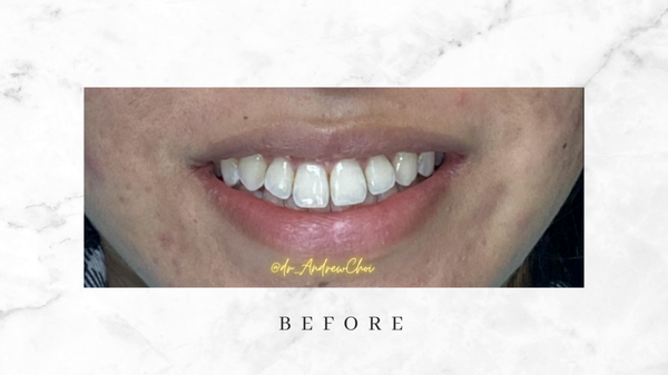 Invisalign Braces: Straighter Teeth - FREE INVISALIGN CONSULTATION
The patient had braces before but without the use of retainers, the teeth moved again. Just 6 months of Invisalign got her back to straighter teeth.
Call us for details! Invisalign Braces: Straighter Teeth - FREE INVISALIGN CONSULTATION
The patient had braces before but without the use of retainers, the teeth moved again. Just 6 months of Invisalign got her back to straighter teeth.
Call us for details!