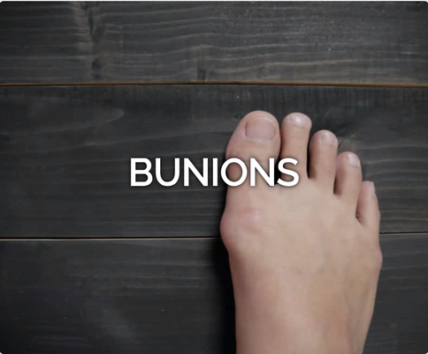 Bunions - A bunion is a bony bump that forms on the joint at the base of your big toe. They can develop from an inherited structural defect, excess stress on your foot, or can result from an existing medical condition.
For the most part, bunions require no medical treatment. However, if you are experiencing one or more of the following, a podiatrist can help alleviate your symptoms:
Persistent big toe or foot pain
A visible bump on your big toe joint
Decreased movement of your big toe or foot
Difficulty finding shoes that fit properly
If you have any questions about our services, please contact us today! Bunions - A bunion is a bony bump that forms on the joint at the base of your big toe. They can develop from an inherited structural defect, excess stress on your foot, or can result from an existing medical condition.
For the most part, bunions require no medical treatment. However, if you are experiencing one or more of the following, a podiatrist can help alleviate your symptoms:
Persistent big toe or foot pain
A visible bump on your big toe joint
Decreased movement of your big toe or foot
Difficulty finding shoes that fit properly
If you have any questions about our services, please contact us today!