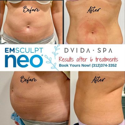 Coolsculpting Elite - EmSculpt Neo using electromagnetic field and RF to stimulate muscle tone and dissolve fat tissue. Coolsculpting Elite - EmSculpt Neo using electromagnetic field and RF to stimulate muscle tone and dissolve fat tissue.