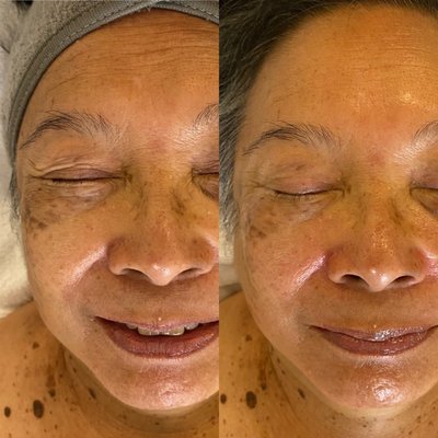 Before and After Facials - At Every Piece Salon we offer Diamond Hydro Facials and Massage Remedy Facials. Whether you're seeking intense hydration, skin repair and renewal, acne treatment, tightening and lifting, or fading those stubborn dark spots, we have the perfect solution for you. We aim to provide you with exceptional results, ensuring you leave our salon feeling confident and rejuvenated. Give us a call at (808) 517-1000 or visit our website at www.everypiecesalon.com for more information.