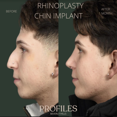 Why Choose Profiles - Primary
and
Revision Rhinoplasty
Recognized Top Rhinoplasty Surgeons the World Over
At Profiles Beverly Hills, our reputation is anchored in the exceptional skill and artistry of LA's top plastic surgeons, Drs. Litner and Solieman. With more than 250 rhinoplasties annually, Drs. Litner and Solieman are dedicated to achieving aesthetic excellence and functional perfection in rhinoplasty and revision rhinoplasty. Why Choose Profiles - Primary
and
Revision Rhinoplasty
Recognized Top Rhinoplasty Surgeons the World Over
At Profiles Beverly Hills, our reputation is anchored in the exceptional skill and artistry of LA's top plastic surgeons, Drs. Litner and Solieman. With more than 250 rhinoplasties annually, Drs. Litner and Solieman are dedicated to achieving aesthetic excellence and functional perfection in rhinoplasty and revision rhinoplasty.