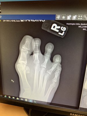 Foot injuries treatment - Foot injuries treatment before and after Foot injuries treatment - Foot injuries treatment before and after