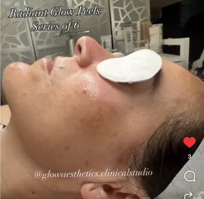 ✨ Featuringaa this amazing before & after from our Radiant Glow Peel Series (6 treatments)! ✨ - ✨ Featuringaa this amazing before & after from our Radiant Glow Peel Series (6 treatments)! ✨
Our gorgeous patient came in with concerns of:
🌸 Uneven texture
🌸 Hyperpigmentation
🌸 Fine lines
🌸 Enlarged pores
🌸 Sun damage
After a thorough consultation and skin analysis, we created a customized treatment plan + skincare regimen tailored to her specific needs. 💎
Fast forward through her series… look at these results! 🌟 We reached her goal and she’s glowing!
At Glow Aesthetics, we don’t just treat the surface—we design a plan to address the root of your skin concerns so you can love the skin you’re in. 💖
Thank you for trusting us on your skincare journey! 🫶
📍 @glowaesthetics.clinicalstudio | Temecula Wine Country
#temeculawinecountry #temeculaesthetician #clinicalskincare #professionalskincare #temeculapeel #murrieta #menifee #wildomar #fallbrook #winchester #escondido #frenchvalley #skintransformation #glowaesthetics ✨ Featuringaa this amazing before & after from our Radiant Glow Peel Series (6 treatments)! ✨ - ✨ Featuringaa this amazing before & after from our Radiant Glow Peel Series (6 treatments)! ✨
Our gorgeous patient came in with concerns of:
🌸 Uneven texture
🌸 Hyperpigmentation
🌸 Fine lines
🌸 Enlarged pores
🌸 Sun damage
After a thorough consultation and skin analysis, we created a customized treatment plan + skincare regimen tailored to her specific needs. 💎
Fast forward through her series… look at these results! 🌟 We reached her goal and she’s glowing!
At Glow Aesthetics, we don’t just treat the surface—we design a plan to address the root of your skin concerns so you can love the skin you’re in. 💖
Thank you for trusting us on your skincare journey! 🫶
📍 @glowaesthetics.clinicalstudio | Temecula Wine Country
#temeculawinecountry #temeculaesthetician #clinicalskincare #professionalskincare #temeculapeel #murrieta #menifee #wildomar #fallbrook #winchester #escondido #frenchvalley #skintransformation #glowaesthetics