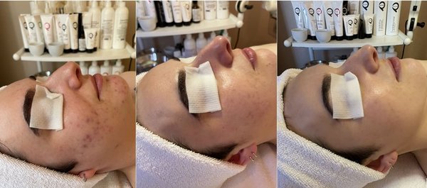 Progression of Acne Healing - From left to right:

Far left photo taken at first visit prior to treatment

Middle photo taken at second visit prior to treatment

Far right photo taken at fourth visit prior to treatment

This progression of acne healing shows results from our Curative Facial and six months on our ProCorrective Clear-Control Blemished Skin line.

Struggling with persistent acne? Book your Curative Facial today!