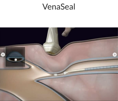VenaSeal - Do you have any of the following signs, symptoms or history?
Varicose Veins
Spider Veins
Leg Pain
Leg Swelling
Restless Legs or Restless Leg Syndrome
Swelling of the feet
Venous Ulcer
Darkened Pigment in the calf or ankle
Unsuccessful Sclerotherapy
Pelvic Varicose Veins
History of Deep Vein Thrombosis (DVT)
History of Superficial Vein Thrombosis (SVT) or Phlebitis
Lymphedema