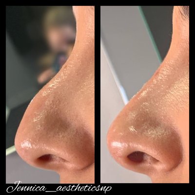 Nose filler - Liquid rhinoplasty AKA nose filler, performed over 2-3 sessions Nose filler - Liquid rhinoplasty AKA nose filler, performed over 2-3 sessions