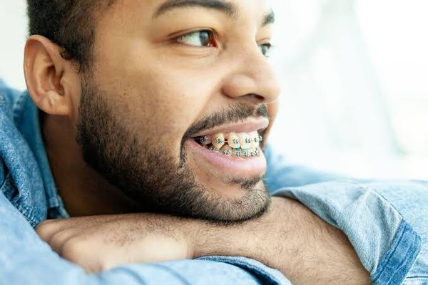 Adult Orthodontic Treatment - TRADITIONAL BRACES or CLEAR ALIGNERS?  The choice is yours!  Adults have more options than ever when it comes to orthodontic treatment.  Traditional braces provide a time tested way to straighten teeth, while clear aligners offer a discreet alternative that fits easily into your daily life.  Together, we'll determine which option is right for you.