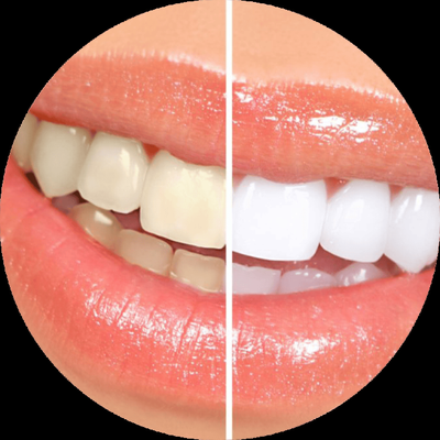 Zoom ® Teeth Whitening In Orange County - Zoom® Teeth whitening in Orange County is the most popular method of teeth whitening, but this does not mean that is your best option for teeth whitening. Our whitening methods are effective at removing deep stains that you may have struggled with for years, not just surface stains. With our processes, you can walk in with a dull smile and walk out with teeth that are several shades whiter in just an hour. At Affinity Dental Center we offer a variety of whitening options for home as well as the popular one hour in office Teeth Whitening. Zoom ® Teeth Whitening In Orange County - Zoom® Teeth whitening in Orange County is the most popular method of teeth whitening, but this does not mean that is your best option for teeth whitening. Our whitening methods are effective at removing deep stains that you may have struggled with for years, not just surface stains. With our processes, you can walk in with a dull smile and walk out with teeth that are several shades whiter in just an hour. At Affinity Dental Center we offer a variety of whitening options for home as well as the popular one hour in office Teeth Whitening.