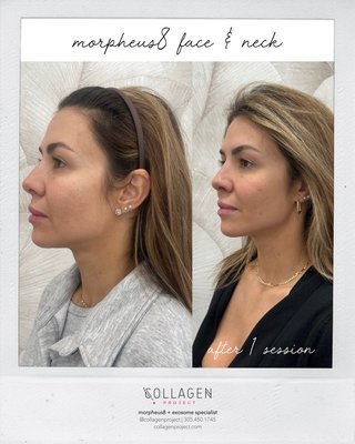 full face + neck skin tightening and contour - If you are just starting to see the early signs of aging on the lower face and want to stay ahead of it, if you look in the mirror and find yourself pulling your skin back on your lower face, if you find yourself wondering if its too early to get a facelift - then yes! You are the perfect candidate and Morpheus8 is your solution.

We highly recommend this combo as your best value all-encompassing anti-aging treatment plan.  For anyone starting to see the signs of collagen loss and aging Morpheus8 micro-needling is a revolutionary non-surgical cosmetic treatment that can address many skin concerns, including fine lines and wrinkles, acne scars, hyperpigmentation, and uneven skin texture. The treatment involves using tiny needles to create microchannels in the skin, stimulating collagen and elastin production, resulting in smoother, firmer, and more youthful-looking skin.

Morpheus 8 can lift and tighten the skin without incisions or surgery, it’s the perfect treatment if you are looking for gradual, scar-less skin correction and collagen building. As an advanced microneedling treatment, it penetrates deep into the skin and fat, rejuvenating aging facial features and providing the benefits of a facelift without the need for surgery.

The basis for Morpheus8, fractional RF energy, is scientifically proven to 

* lift and tighten loose skin

* rebuild collagen (tighten skin)

* remodel fat

* reduce fine lines and wrinkles 

* improve skin texture

* minimize acne scarring