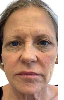 RF Needling with Sylfirm X Skin Tightening - Experience advanced skin tightening with SylfirmX Continuous Wave (CW) RF technology—the only RF needling device proven to safely tighten EYELIDS (all the way to the lash line on both upper and lower lids) as well as the rest of your face, neck, chest or any other body area you choose. Backed by dozens of clinical studies, this treatment is both quick and comfortable and has little-to-no downtime! RF Needling with Sylfirm X Skin Tightening - Experience advanced skin tightening with SylfirmX Continuous Wave (CW) RF technology—the only RF needling device proven to safely tighten EYELIDS (all the way to the lash line on both upper and lower lids) as well as the rest of your face, neck, chest or any other body area you choose. Backed by dozens of clinical studies, this treatment is both quick and comfortable and has little-to-no downtime!