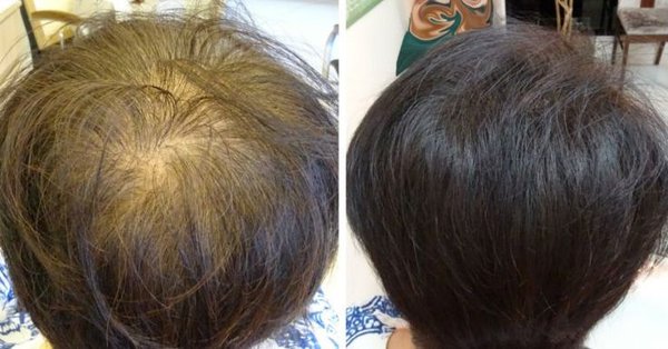 Hair Density Restoration with SMP - At Grizzly Scalp, we recently worked with a client who was experiencing noticeable thinning on the crown and top of the head. While the client still had natural hair, the scalp was visible, creating a patchy appearance and reducing overall density.
To solve this, we performed our Density Effect Scalp Micropigmentation (SMP) treatment. By carefully color-matching the pigment to the client’s natural hair and strategically placing micro impressions between the existing hairs, we created the look of thicker, fuller hair.
The final result was incredibly natural, the scalp is no longer visible, and the client’s hair looks healthy and dense. More importantly, the client walked out with renewed confidence and a fresh, natural look. Hair Density Restoration with SMP - At Grizzly Scalp, we recently worked with a client who was experiencing noticeable thinning on the crown and top of the head. While the client still had natural hair, the scalp was visible, creating a patchy appearance and reducing overall density.
To solve this, we performed our Density Effect Scalp Micropigmentation (SMP) treatment. By carefully color-matching the pigment to the client’s natural hair and strategically placing micro impressions between the existing hairs, we created the look of thicker, fuller hair.
The final result was incredibly natural, the scalp is no longer visible, and the client’s hair looks healthy and dense. More importantly, the client walked out with renewed confidence and a fresh, natural look.