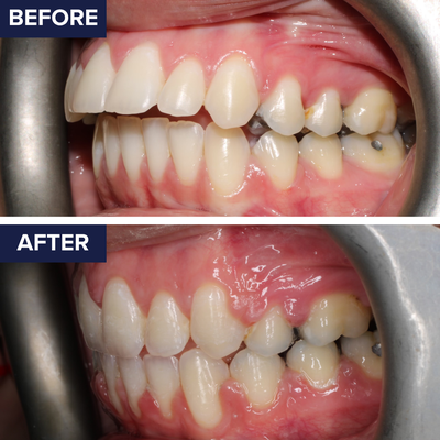 Bite Correction - Orthodontic Treatment - See the difference expert orthodontic care can make! These before-and-after photos showcase remarkable bite corrections that improved both function and aesthetics using braces and Invisalign®. From misaligned bites to beautifully balanced smiles—real results, real confidence.
Our team specializes in personalized treatments designed to perfect your bite and transform your smile.
✨ Ready for your own before-and-after moment? Schedule your consultation today! Bite Correction - Orthodontic Treatment - See the difference expert orthodontic care can make! These before-and-after photos showcase remarkable bite corrections that improved both function and aesthetics using braces and Invisalign®. From misaligned bites to beautifully balanced smiles—real results, real confidence.
Our team specializes in personalized treatments designed to perfect your bite and transform your smile.
✨ Ready for your own before-and-after moment? Schedule your consultation today!