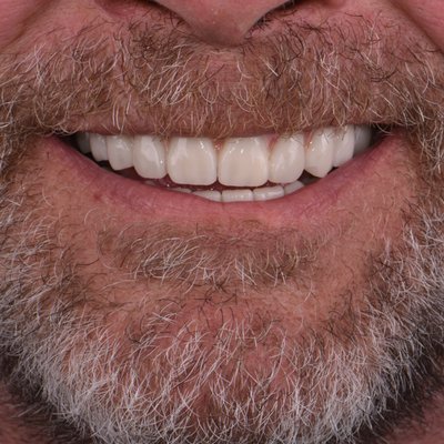 Zirconia Superstructure✅ - What makes this treatment unique? It offers durability, aesthetics, and a natural smile that fits perfectly with your mouth. Your smile deserves the best! 🦷 Zirconia Superstructure✅ - What makes this treatment unique? It offers durability, aesthetics, and a natural smile that fits perfectly with your mouth. Your smile deserves the best! 🦷