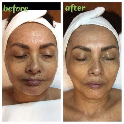 Microdermabrasion/ Hydrafacial/ facial/ back facial/ acne treatment/ LED light therapy/ - Getting a facial is not only relaxing and rejuvinating to the face, but also the mind. Facials allow you to focus on your breathing and regain your confidence in having healthy beautiful skin. Monthly facials help to support your at home skincare program to achieve the healthiest skin possible. Here are 4 benefits to monthly facials:
1. Reduce Stress And Relieve Psychological Distress:
2. Deep Cleaning:
3. Skin Rejuvenation:
4. Slow The Aging Process:
5. Improved Circulation:
6. Facials Help Detoxify The Skin:
7. Treat Acne And Acne Marks;
8. Eliminate Whiteheads And Blackheads:
9. Open Up All The Pores:
10. Exfoliate Your Skin
11. Tighten Your Skin:
12. Eliminate Under Eye Bags And Dark Circles: Microdermabrasion/ Hydrafacial/ facial/ back facial/ acne treatment/ LED light therapy/ - Getting a facial is not only relaxing and rejuvinating to the face, but also the mind. Facials allow you to focus on your breathing and regain your confidence in having healthy beautiful skin. Monthly facials help to support your at home skincare program to achieve the healthiest skin possible. Here are 4 benefits to monthly facials:
1. Reduce Stress And Relieve Psychological Distress:
2. Deep Cleaning:
3. Skin Rejuvenation:
4. Slow The Aging Process:
5. Improved Circulation:
6. Facials Help Detoxify The Skin:
7. Treat Acne And Acne Marks;
8. Eliminate Whiteheads And Blackheads:
9. Open Up All The Pores:
10. Exfoliate Your Skin
11. Tighten Your Skin:
12. Eliminate Under Eye Bags And Dark Circles: