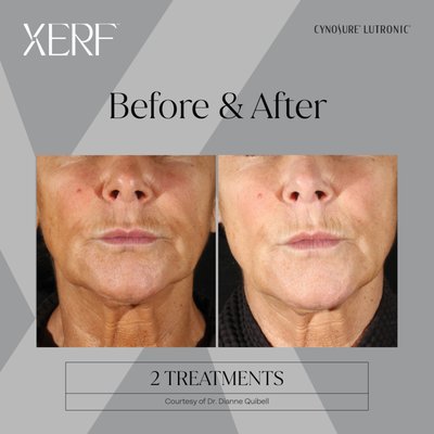 XERF RF Tightening - Lift. Tighten. Rejuvenate.
Experience firmer, smoother, more youthful-looking skin with XERF RF Tightening. This advanced radiofrequency treatment delivers controlled heat deep into the skin to stimulate collagen and elastin production, helping tighten loose skin, improve facial contours, and reduce the appearance of fine lines and wrinkles—all without surgery or downtime.
Benefits:
Tightens loose or sagging skin
Stimulates natural collagen and elastin production
Improves facial definition and contours
Softens fine lines and wrinkles
Smooths and firms the skin
Comfortable treatment with little to no downtime
Safe for most skin types XERF RF Tightening - Lift. Tighten. Rejuvenate.
Experience firmer, smoother, more youthful-looking skin with XERF RF Tightening. This advanced radiofrequency treatment delivers controlled heat deep into the skin to stimulate collagen and elastin production, helping tighten loose skin, improve facial contours, and reduce the appearance of fine lines and wrinkles—all without surgery or downtime.
Benefits:
Tightens loose or sagging skin
Stimulates natural collagen and elastin production
Improves facial definition and contours
Softens fine lines and wrinkles
Smooths and firms the skin
Comfortable treatment with little to no downtime
Safe for most skin types