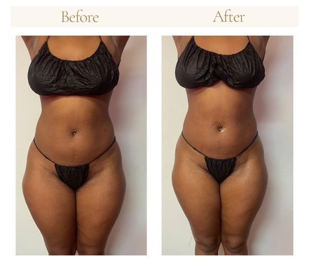 Our Work In Progress - Our Results From Body Sculpting Treatments and Post Op Care Our Work In Progress - Our Results From Body Sculpting Treatments and Post Op Care