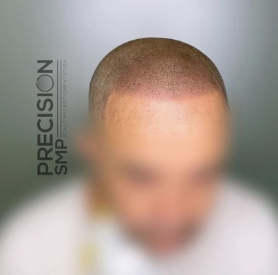 SMP Treatments - Sessions are spaced out 2 weeks apart and each session lasts anywhere from 1 to 4 hours. SMP Treatments - Sessions are spaced out 2 weeks apart and each session lasts anywhere from 1 to 4 hours.