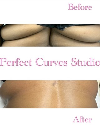 Cavitation Back Fat Molding - Cavitation and hand molding with Radio Frequency Skin Tightening and wood therapy that reduces the apperance of the back rolls.
