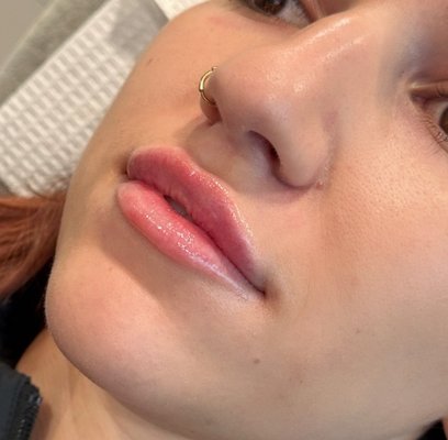 Lip Filler - With the use of Restylane and Juvederm fillers, our aesthetic injectors use their knowledge and skills to hydrate and plump your lips while enhancing your natural features. Lip Filler - With the use of Restylane and Juvederm fillers, our aesthetic injectors use their knowledge and skills to hydrate and plump your lips while enhancing your natural features.