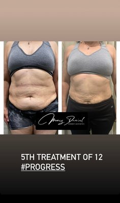 12 session laser Body Sculpt treatments - Each client gets a customized plan and is given Laser body sculpt treatments weekly. Some just need the one session to kick start their inch loss on those stubborn areas.
I don't just use one device on every single body or case, I use it all and do it all. My goal is to give each and every case I take on the ultimate and best results.