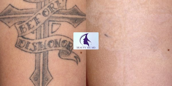 PicoSure Tattoo Removal - PicoSure Tattoo Removal: delivers energy so rapidly (in trillionths of a second) that tiny particles that make up pigment and tattoo ink vibrate and shatter, without burning surrounding tissue. Less heat means less tissue damage and discomfort.