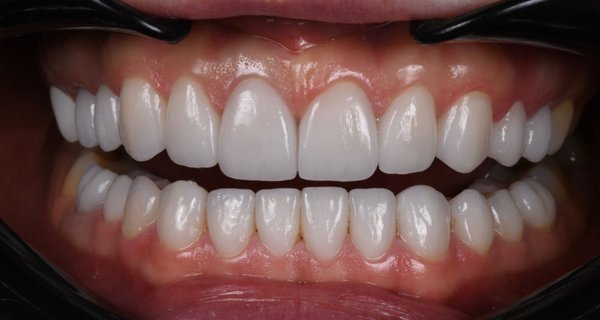 Smile Refresh with Procelain Veneers in Newport Beach, CA - This patient scheduled a virtual consultation with Spath Dentistry. She had a previous 20 unit bonding case that was due for a serious refresh. Our Newport Beach cosmetic dentists replaced the bonding with veneers for a stunning smile transformation.