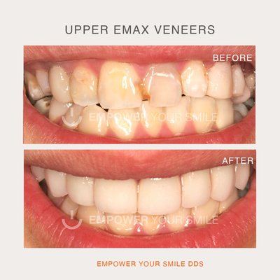 veneers - BEFORE AND AFTER TREATMENT
PATIENTS WITH VARIOUS CAVITIES IN THE ANTERIOR ELEMENTS, INCISAL FRACTURES AND COLOR CHANGES. 8 CERAMIC VENEERS WERE MADE IN THE UPPER JAW, FOR WHICH MINIMAL WEAR WAS MADE ON THE VESTIBULAR SIDE OF THE TEETH. THE COLOR CHANGE IN THIS PATIENT WAS FROM A3 to A1 veneers - BEFORE AND AFTER TREATMENT
PATIENTS WITH VARIOUS CAVITIES IN THE ANTERIOR ELEMENTS, INCISAL FRACTURES AND COLOR CHANGES. 8 CERAMIC VENEERS WERE MADE IN THE UPPER JAW, FOR WHICH MINIMAL WEAR WAS MADE ON THE VESTIBULAR SIDE OF THE TEETH. THE COLOR CHANGE IN THIS PATIENT WAS FROM A3 to A1