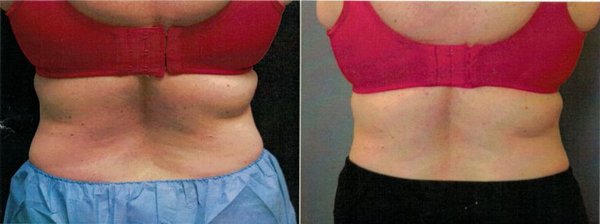 CoolSculpting - What is CoolSculpting®?
CoolSculpting ® is the coolest, most innovative, non-surgical skin treatment way to lose those annoying bumps and bulges of stubborn fat. This revolutionary technology targets and cools unwanted fat cells in the selected area to induce a noticeable, natural-looking reduction in fat bulges.

Empty heading
Unlike most other methods of fat reduction, CoolSculpting ® in our Alameda and Brentwood practice involves no needles, surgery, or downtime. Patients often spend procedure time reading, working on their laptops, or simply relaxing. It’s safe, FDA-cleared and effective. Results look natural and can be seen as early as three weeks following treatment, with the most dramatic results after one to three months.

What to expect during the CoolSculpting® procedure?
CoolSculpting ® is completely non-surgical, so typically you can return to normal activities immediately. Some patients experience redness, minor bruising, tingling, numbness or discomfort in the treated area, but this is temporary and will resolve completely. Often times, patients return to work after the session is over.

To initiate the treatment we will position the device on your body. The device will then draw the bulge up between two cooling panels. The sensation is a firm pull and pressure – enough of a pull to ensure the selected tissue will be cooled most efficiently. An hour or so later, depending on your needs, you’re done.

What to expect during the recovery for the CoolSculpting®?
There is no required recovery time and many patients are able to immediately resume their daily activities without a hindrance caused by surgery. There is no downtime with this procedure for most individuals, in-fact, many patients drive straight to work after the procedure. Some patients experience side-affects after the treatment, including bruising, swelling, a tingling sensation, and small aches. These effects are resolved within the first few weeks.

You may start to see changes as quickly as three weeks after your treatment, and will experience the most dramatic results after one to three months. Your body is still flushing fat cells and will continue doing so for up to four to six months after treatment.

Many patients are satisfied after one treatment. However, during your consultation, we can discuss a treatment plan that will meet your specific treatment needs. CoolSculpting B&A Pictures & Testimonials Header: Cool Technology. Even Cooler Results.
