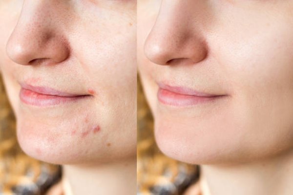 Facials - I offer a wide range of facials using Image Skincare. I provide facials to treat acne, anti-aging, & sensitive skin. I also do customized back facials to treat either acne or dry/dehydrated skin. Facials - I offer a wide range of facials using Image Skincare. I provide facials to treat acne, anti-aging, & sensitive skin. I also do customized back facials to treat either acne or dry/dehydrated skin.