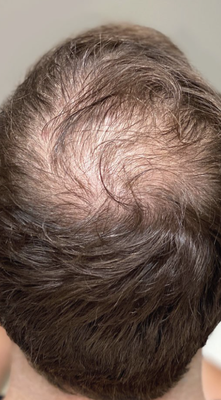 PRP Hair Treatment - Platelet-Rich Plasma (PRP) hair restoration is a cutting-edge, non-surgical treatment that uses your body’s own natural healing power to stimulate hair growth. During the procedure, a small amount of your blood is drawn and processed to concentrate the platelets—rich in growth factors that promote tissue repair and regeneration. This platelet-rich plasma is then carefully injected into areas of the scalp where hair is thinning, helping to strengthen hair follicles, improve hair density, and encourage natural regrowth.
PRP is safe, minimally invasive, and requires little to no downtime, making it an excellent option for both men and women experiencing early stages of hair loss or thinning. With a series of treatments, patients can see noticeable improvements in hair thickness, strength, and overall scalp health. PRP Hair Treatment - Platelet-Rich Plasma (PRP) hair restoration is a cutting-edge, non-surgical treatment that uses your body’s own natural healing power to stimulate hair growth. During the procedure, a small amount of your blood is drawn and processed to concentrate the platelets—rich in growth factors that promote tissue repair and regeneration. This platelet-rich plasma is then carefully injected into areas of the scalp where hair is thinning, helping to strengthen hair follicles, improve hair density, and encourage natural regrowth.
PRP is safe, minimally invasive, and requires little to no downtime, making it an excellent option for both men and women experiencing early stages of hair loss or thinning. With a series of treatments, patients can see noticeable improvements in hair thickness, strength, and overall scalp health.