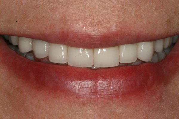 Smile Makeover - A smile is one of the first things people notice, and everyone deserves to have a smile they love to share. In the "before" photo, you can see a smile that, while genuine, was held back by discoloration and unevenness that can happen over time. We see the potential for a truly radiant smile waiting to be revealed.
Now, look at the "after" photo. This is more than just a dental procedure; it's a transformation. The teeth are luminous, beautifully shaped, and perfectly aligned, creating a look of natural and vibrant health. This is the kind of confident, dazzling smile that lights up a room and allows your true personality to shine through without hesitation. It’s the result of artistry, expertise, and a deep understanding of our patient's desires.
This change is about more than just aesthetics; it’s about restoring confidence and the simple joy of smiling freely for photos, laughing without a second thought, and engaging with the world with newfound assurance.
Imagine the possibilities for your own smile. If you've been dreaming of a brighter, more confident you, let us help you make it a reality.
Contact us today to begin your own transformation journey! Smile Makeover - A smile is one of the first things people notice, and everyone deserves to have a smile they love to share. In the "before" photo, you can see a smile that, while genuine, was held back by discoloration and unevenness that can happen over time. We see the potential for a truly radiant smile waiting to be revealed.
Now, look at the "after" photo. This is more than just a dental procedure; it's a transformation. The teeth are luminous, beautifully shaped, and perfectly aligned, creating a look of natural and vibrant health. This is the kind of confident, dazzling smile that lights up a room and allows your true personality to shine through without hesitation. It’s the result of artistry, expertise, and a deep understanding of our patient's desires.
This change is about more than just aesthetics; it’s about restoring confidence and the simple joy of smiling freely for photos, laughing without a second thought, and engaging with the world with newfound assurance.
Imagine the possibilities for your own smile. If you've been dreaming of a brighter, more confident you, let us help you make it a reality.
Contact us today to begin your own transformation journey!
